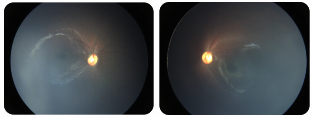 早產(chǎn)兒視網(wǎng)膜病變